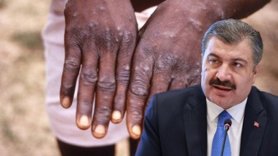 Bir pandemi daha mı geliyor? Bakan Koca,  maymun çiçeği virüsü hakkında net konuştu