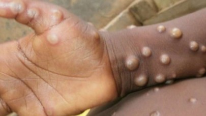 Koronadan sonra yeni virüs alarmı: Ölümcül virüs iki ülkeye daha sıçradı!