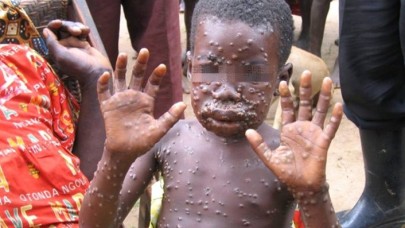 Maymun çiçeği virüsü yayılıyor: Hastalığın belirtileri ortaya çıktı!