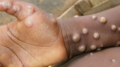 Sağlık Bakanlığı'ndan flaş maymun çiçeği virüsü açıklaması! Türkiye'de görüldü mü?