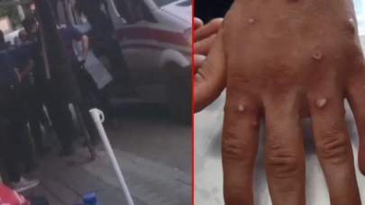 İstanbul'da maymun çiçeği alarmı: 3 Afgan özel ekiplerle alındı!