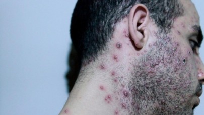 Türkiye'de ilk maymun çiçeği vakası görüldü: Belirtileri ortaya çıktı