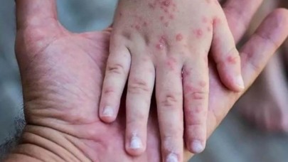 Bakan Koca'dan korkutan açıklama: Maymun çiçeği vakası yükseldi