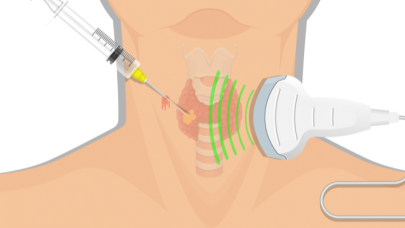 Hastalığa özgün ve en etkili tedavi biyopsiyle belirleniyor