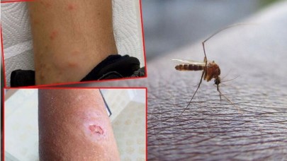 İstanbul'da sivrisinek kabusu! Hastaneler dolup taştı,  hedeflerinde iki kan grubu var