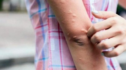 Vaka sayıları artınca yetkililer harekete geçti! Sağlık Bakanlığı'nın yayınladığı sivrisinekten korunma rehberi