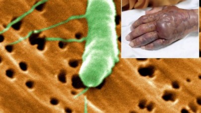 'Et yiyen bakteri' kabusu: Bu belirtilere dikkat!