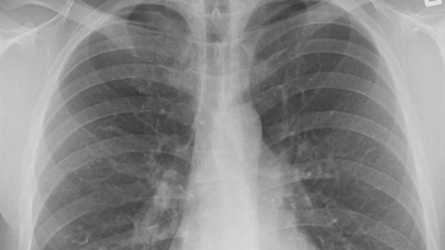 Pasif içicilerde "akciğer kanseri" riski yüzde 30 artıyor