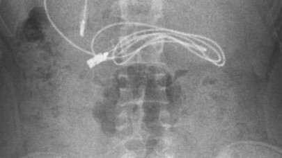 Anne ve babalar dikkat! 15 yaşındaki çocuğun midesinden çıkanlar şaşkına çevirdi