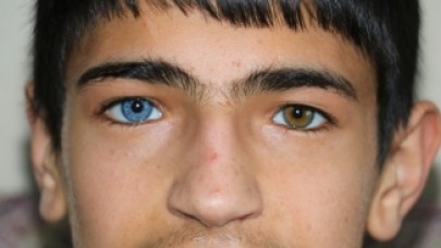 Bir Gözü Mavi Diğeri Kahverengi Olan Çocuklar Görenleri Şaşırtıyor