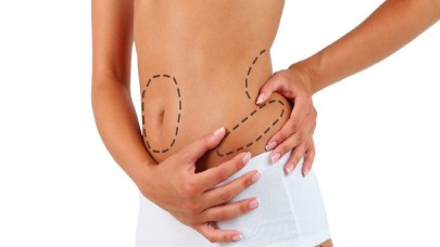 Liposuction Nedir ve İşlemi Nasıl Gerçekleşir?