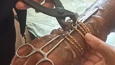 Kolu yanan kadının bilezikleri itfaiye tarafından kesilerek çıkarıldı