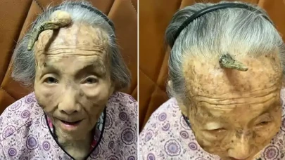 Çin'de 107 yaşındaki kadının alnında boynuz çıktı
