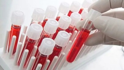 Felç riski en yüksek kan grubu belli oldu