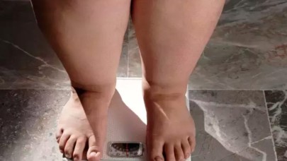 Bu genetik hastalık sadece kadınlarda görülüyor: Lipödem nedir,  nasıl tedavi edilir?