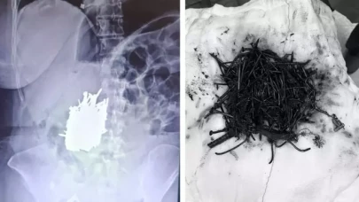 Karın ağrısı şikayetiyle hastaneye gitti: Kadının midesinden çıkanlar hayrete düşürdü!