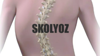 Skolyoz erken teşhis edilmezse tedavisi zorlaşabilir