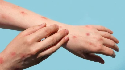 Liberya'da Mpox alarmı: 1308 vaka pozitif çıktı, salgın ülke genelinde yayılıyor