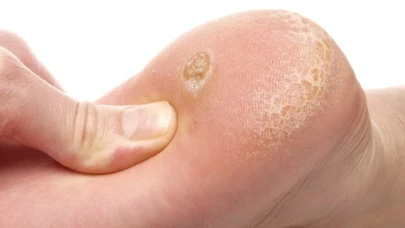 Ayak mantar kreminde en iyisi hangisi?