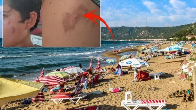 Vatandaşlar tedirgin! Denize giren yanıklarla çıkıyor