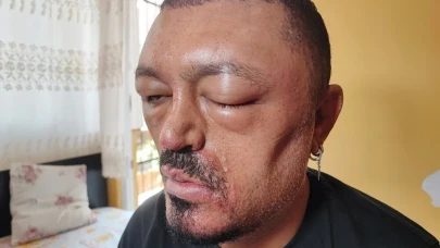 İnternetten aldığı siyahlaştırıcı şampuan kör ediyordu!