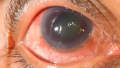 Türkiye’de 2 milyon glokom hastası var! Sessiz ilerliyor, görmeyi kalıcı olarak yok edebilir