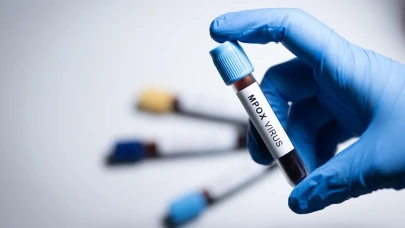 Madagaskar'da Mpox alarmı: Vaka sayısı 78 oldu