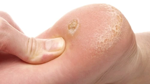 Ayak mantar kreminde en iyisi hangisi?