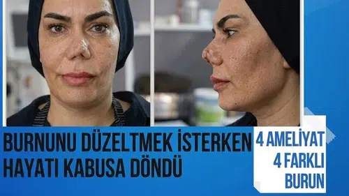 Burnunu düzeltmek isterken hayatı kabusa döndü: 4 ameliyat, 4 farklı burun
