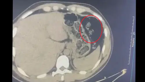 Midesinde uyuşturucuyla yakalanan 2 kişi tutuklandı
