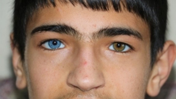 Bir Gözü Mavi Diğeri Kahverengi Olan Çocuklar Görenleri Şaşırtıyor