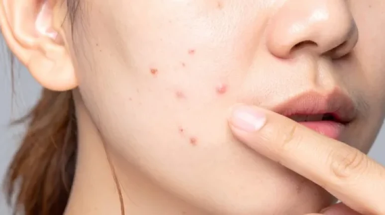 Cilt Lekelerini Gidermede En Etkili Tedavi Yöntemleri