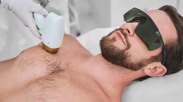 Erkekler İçin Lazer Epilasyon Rehberi