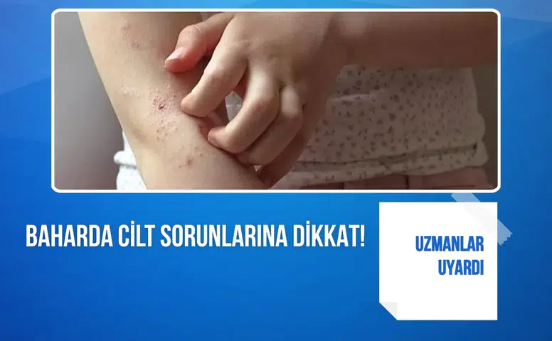 Uzmanlar uyardı: Baharda cilt sorunlarına dikkat